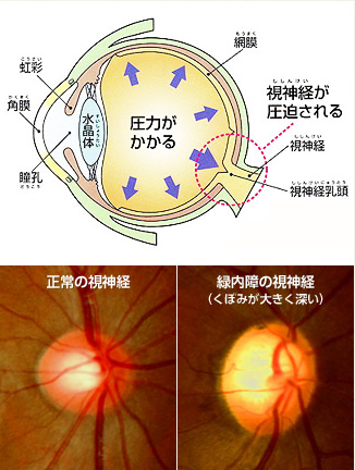 緑内障