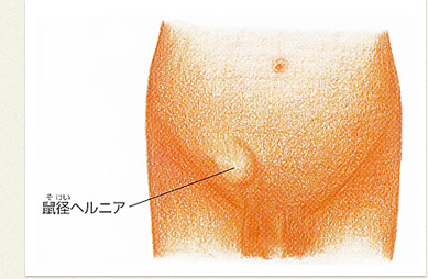 鼠径（そけい）ヘルニア